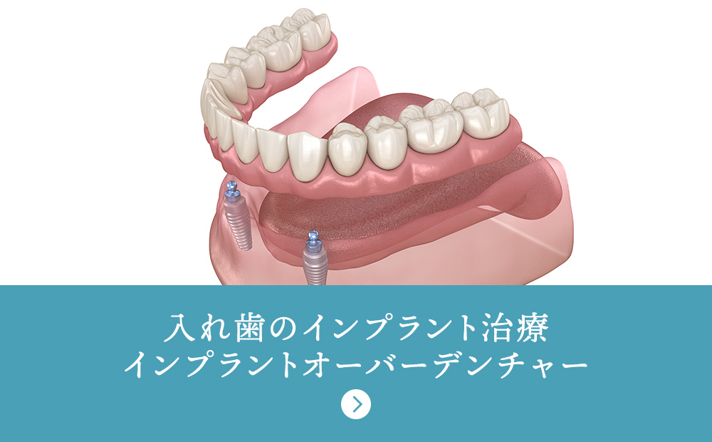 入れ歯のインプラント治療 インプラントオーバーデンチャー