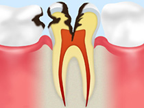 C3（神経に達した虫歯）