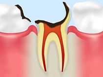C4（歯根に達した虫歯）