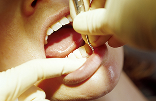 日本人が歯を失う原因の第1位は歯周病です